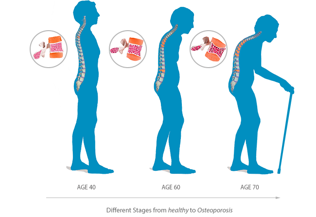 osteoporosis