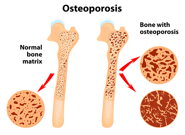 osteoporosis2