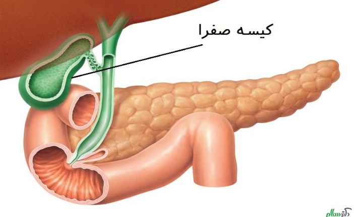 تغذیه درمانی در سنگ کیسه صفرا