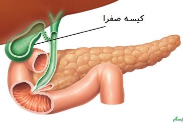 تغذیه درمانی در سنگ کیسه صفرا